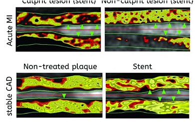 動脈阻塞.jpg 動脈阻塞.jpg