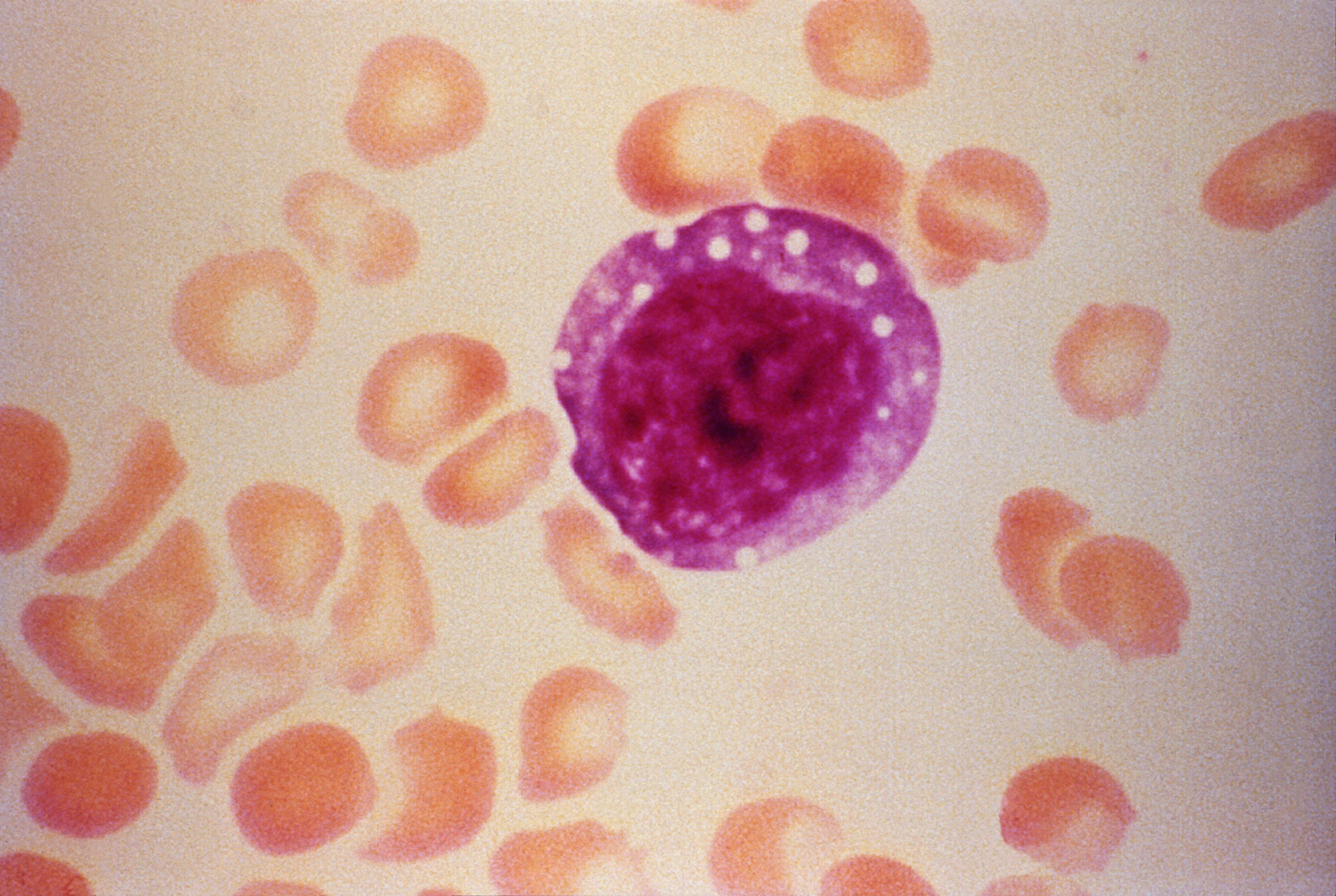 Envisagenics, Cancer Research UK, Queen Mary University Collaborate on AML Drug R&D