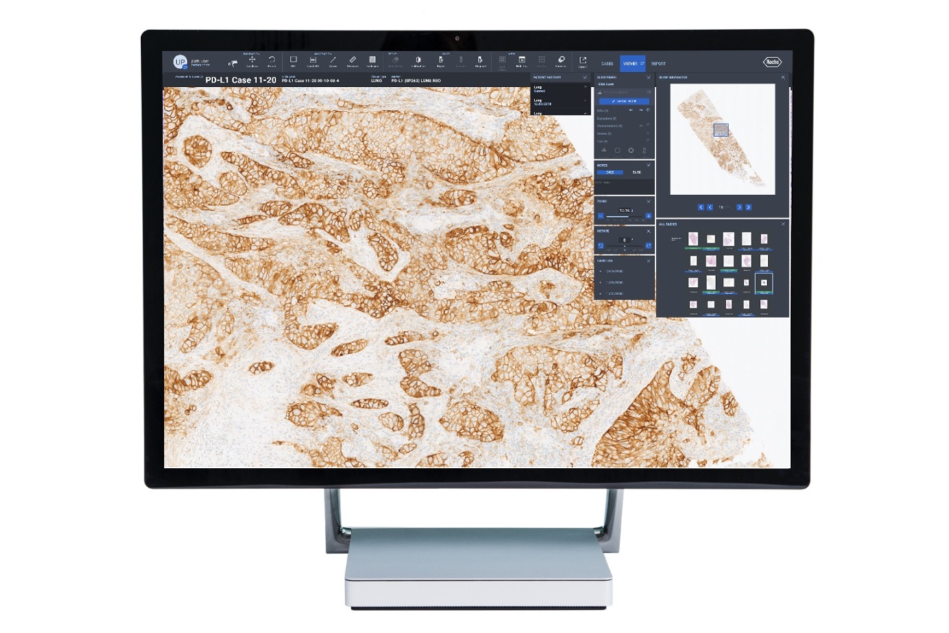 Roche Diagnostics and Deep Informatics collaborate to jointly launch a pathology AI-assisted interpretation algorithm