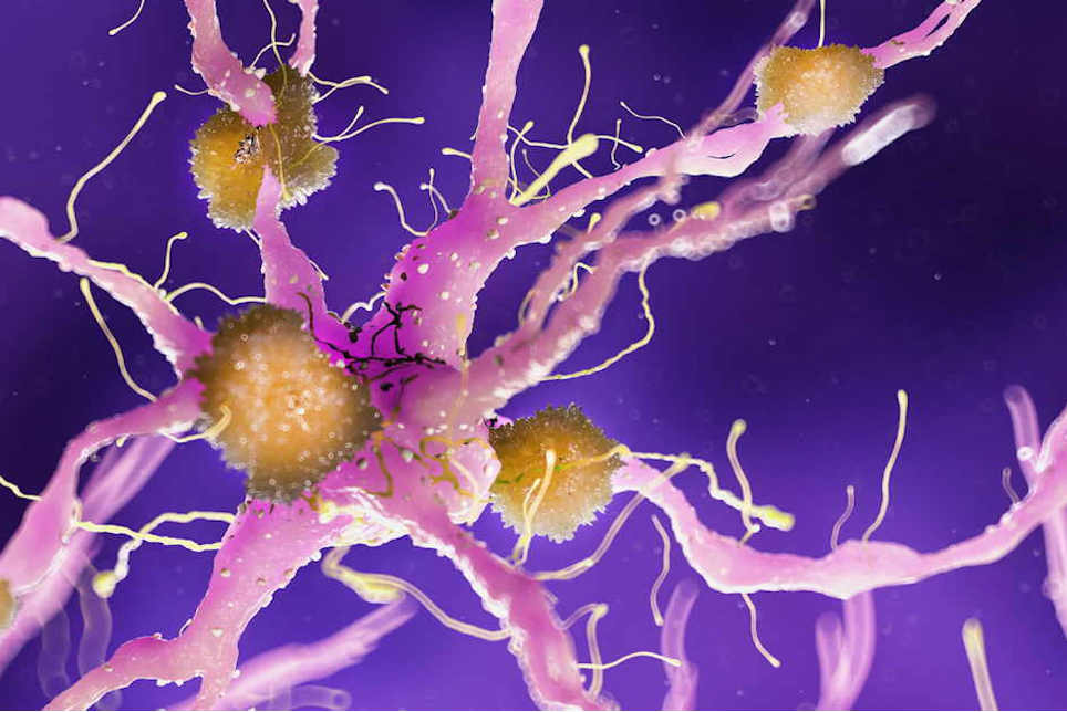 Experts raise concerns about Quest Diagnostics�� consumer-initiated Alzheimer��s test