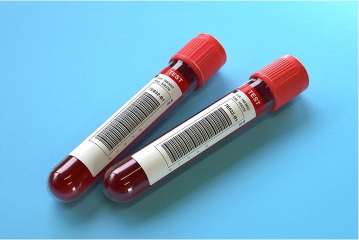 Study shows a frontline Alzheimer��s blood test could be as accurate as spinal fluid exams