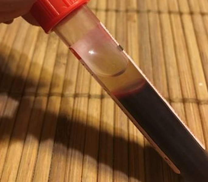 The New Kid on the Liquid Biopsy Block