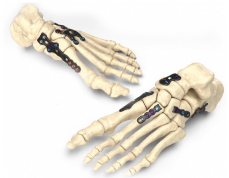 Next-Generation Foot Plating System Aims to Ease Use and Save Time in the Operating Room